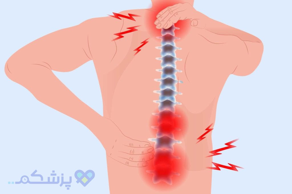 درد ستون فقرات